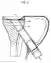 Fig. 07 - Tibial resurfacing system