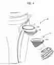 Fig. 10 - Tibial resurfacing system