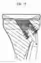 Fig. 12 - Tibial resurfacing system