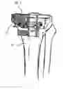 Fig. 01 - ALIGNMENT AND CONNECTION DEVICE OF FEMUR CUTTER AND TIBIA CUTTER AND METHOD OF KNEE ARTHROPLASTY USING THE SAME