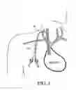 Fig. 02 - Cuffed-catheter removal device