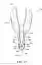Fig. 10 - Cuffed-catheter removal device