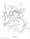 Fig. 02 - Methods and apparatus for atrioventricular valve repair