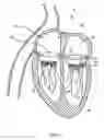 Fig. 03 - Methods and apparatus for atrioventricular valve repair