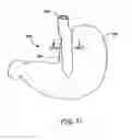 Fig. 22 - Obesity treatment tools and methods