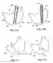 Fig. 28 - Obesity treatment tools and methods