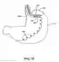 Fig. 29 - Obesity treatment tools and methods