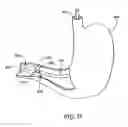 Fig. 32 - Obesity treatment tools and methods