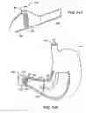 Fig. 33 - Obesity treatment tools and methods