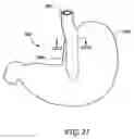 Fig. 22 - Obesity treatment tools and methods