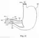 Fig. 32 - Obesity treatment tools and methods