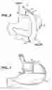 Fig. 04 - Methods and devices for maintaining a space occupying device in a relatively fixed location within a stomach