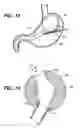 Fig. 08 - Methods and devices for maintaining a space occupying device in a relatively fixed location within a stomach