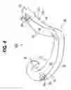 Fig. 05 - Non-snag polymer ligating clip