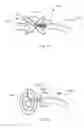 Fig. 07 - System and method for removal of material from a blood vessel using a small diameter catheter
