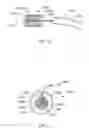 Fig. 08 - System and method for removal of material from a blood vessel using a small diameter catheter