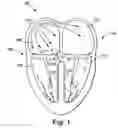 Fig. 02 - Cardiac resynchronization therapy for improved hemodynamics based on disordered breathing detection