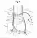 Fig. 02 - System and method to modulate phrenic nerve to prevent sleep apnea