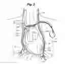 Fig. 03 - System and method to modulate phrenic nerve to prevent sleep apnea