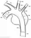 Fig. 01 - Stent/graft assembly