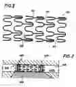 Fig. 02 - Composite stent with regioselective material