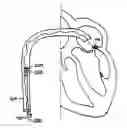Fig. 01 - Methods, devices, and kits for treating mitral valve prolapse