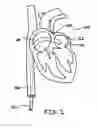 Fig. 02 - Methods, devices, and kits for treating mitral valve prolapse