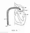 Fig. 03 - Methods, devices, and kits for treating mitral valve prolapse