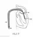 Fig. 04 - Methods, devices, and kits for treating mitral valve prolapse