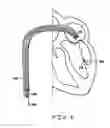 Fig. 08 - Methods, devices, and kits for treating mitral valve prolapse