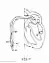 Fig. 09 - Methods, devices, and kits for treating mitral valve prolapse