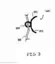 Fig. 10 - Methods, devices, and kits for treating mitral valve prolapse