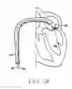 Fig. 12 - Methods, devices, and kits for treating mitral valve prolapse