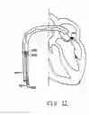 Fig. 13 - Methods, devices, and kits for treating mitral valve prolapse