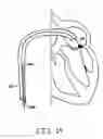 Fig. 16 - Methods, devices, and kits for treating mitral valve prolapse