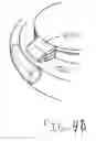 Fig. 07 - Accommodative intraocular lens