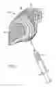 Fig. 02 - Facet joint implant and procedure