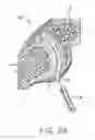 Fig. 03 - Facet joint implant and procedure