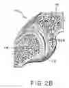 Fig. 04 - Facet joint implant and procedure