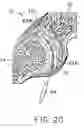 Fig. 05 - Facet joint implant and procedure