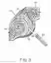 Fig. 06 - Facet joint implant and procedure