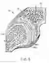 Fig. 08 - Facet joint implant and procedure