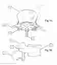 Fig. 02 - Transosseous spine core approach method implant and instrumentation
