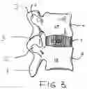 Fig. 04 - Transosseous spine core approach method implant and instrumentation