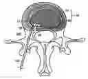 Fig. 01 - Intervertebral anulus and nucleus augmentation