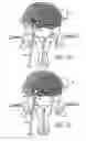 Fig. 22 - Intervertebral anulus and nucleus augmentation