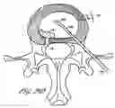 Fig. 33 - Intervertebral anulus and nucleus augmentation