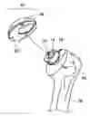 Fig. 01 - Adjustable bone prostheses and related methods related applications