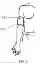 Fig. 03 - Medical electrode glove with partially insulating layer