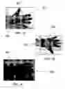 Fig. 04 - Medical electrode glove with partially insulating layer